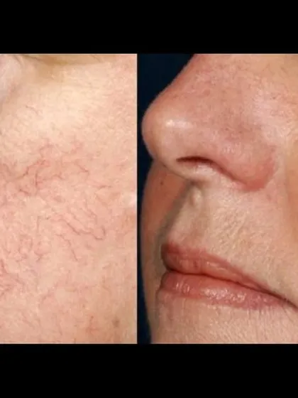 Facial telangiectasias, or small broken blood vessels, can cause persistent redness. I treat these using specific lasers that target the vessels and erase them without harming the surrounding skin, resulting in a clearer complexion.