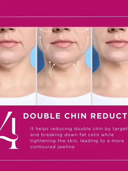 HIFU can significantly reduce a double chin. The focused ultrasound energy targets and breaks down fat cells under the chin while also tightening the surrounding skin, leading to a more defined and contoured jawline.