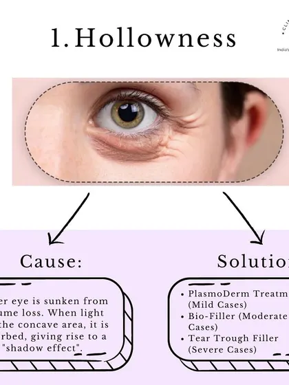 Problem: Hollowness. This is caused by volume loss, creating a shadow effect. Our solutions include PlasmoDerm for mild cases, Bio-Filler for moderate cases, and Tear Trough Filler for severe cases.