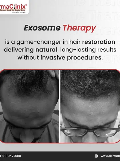 Another powerful before-and-after result from Exosome therapy, demonstrating its effectiveness in restoring hair density.