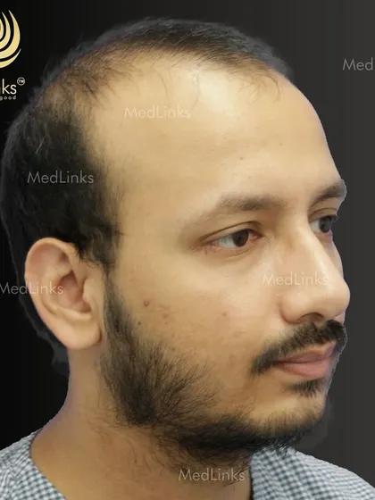 The patient's hair from the side before the procedure.