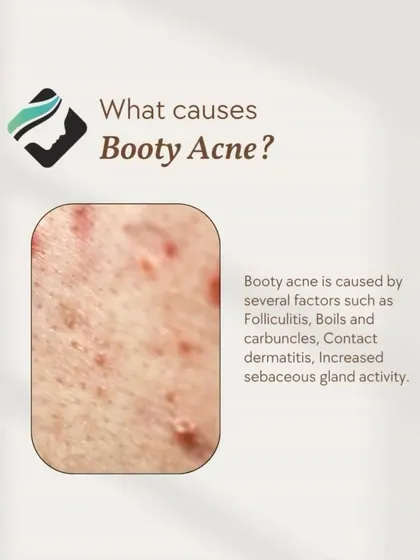 This infographic explains the causes of "booty acne," which is often folliculitis. I offer effective treatments like acne peels to address this common concern.