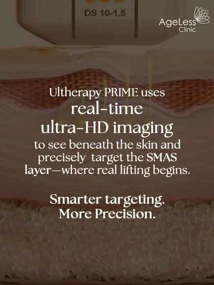 This graphic illustrates the precision of Ultherapy PRIME. The real-time ultra-HD imaging allows me to see beneath the skin and precisely target the SMAS layer. This is where true lifting begins, ensuring smarter targeting for more effective collagen stimulation.