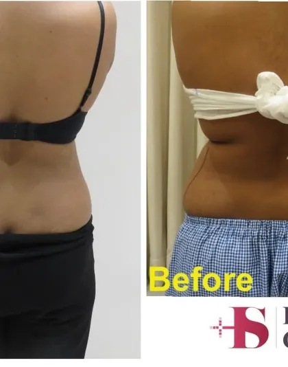 This image shows the results of liposuction on the back and flank area, often called 'love handles'. The procedure effectively smoothed out the rolls of fat, creating a more defined waistline and a smoother transition from the back to the hips.