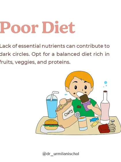 A poor diet lacking essential nutrients can contribute to dark circles. I advise opting for a balanced diet rich in fruits, vegetables, and proteins to support skin health from the inside out.