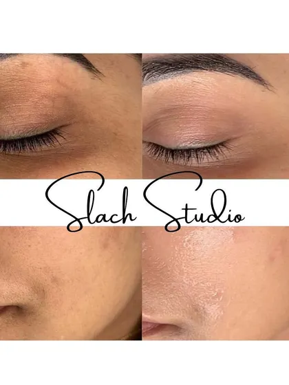 Notice the improvement in both skin texture and tone. The "after" photo shows smoother skin on the eyelid and a reduction in spots on the cheek.