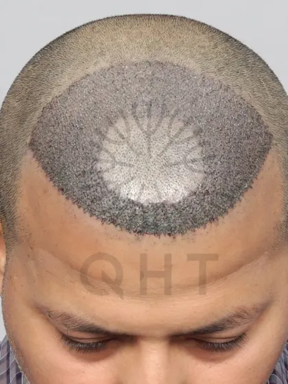 A high-density hair transplant where we preserved the patient's natural frontal tuft while restoring the surrounding areas with 3500 grafts.