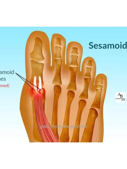 Sesamoiditis is an inflammation of the small bones under the big toe joint, often affecting runners and walkers. This diagram shows exactly where the inflammation occurs, causing pain when pushing off the foot.