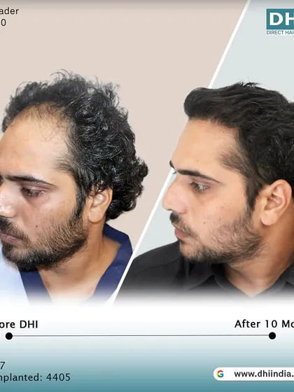 Another side-profile view of the 10-month result. This angle highlights the seamless flow and density from front to back, a testament to the meticulous work of our doctor-led team.