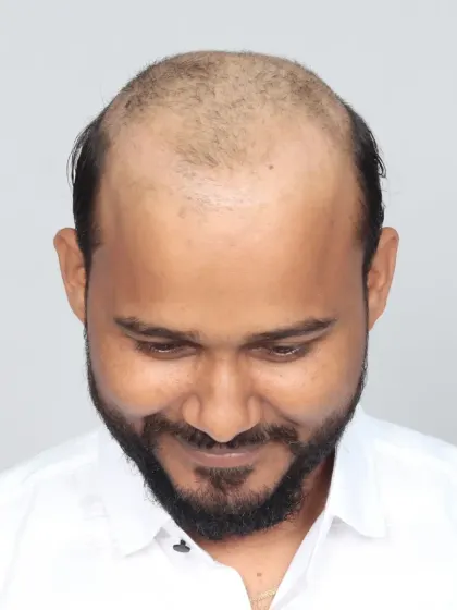 A remarkable 9-month transformation. We used 5000 grafts for hairline restoration and mid-scalp coverage, resulting in visible volume and confidence.