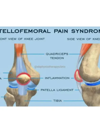 Patellofemoral Pain Syndrome, or "runner's knee," causes pain in the front of the knee. This diagram illustrates how inflammation can occur when the patella (kneecap) tracks incorrectly, often due to muscle imbalances.