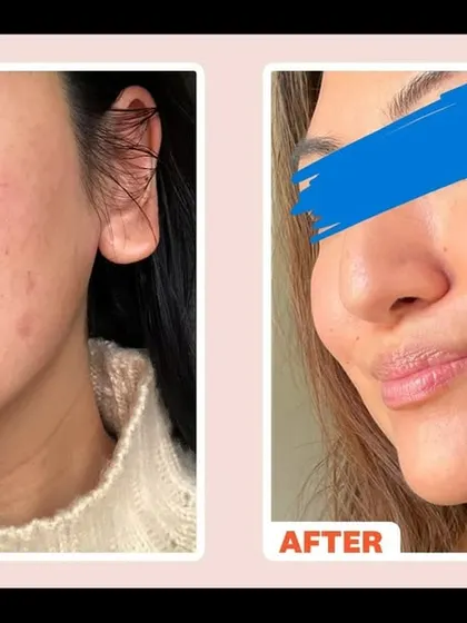 This patient achieved a brighter, more even complexion after MNRF treatments. The procedure not only targets scars but also helps reduce pore size and improve overall skin quality, resulting in a healthy glow.