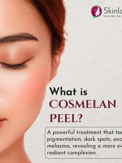 What is a Cosmelan Peel? This image defines it as a powerful treatment that targets pigmentation, dark spots, and melasma to reveal a more even, radiant complexion.