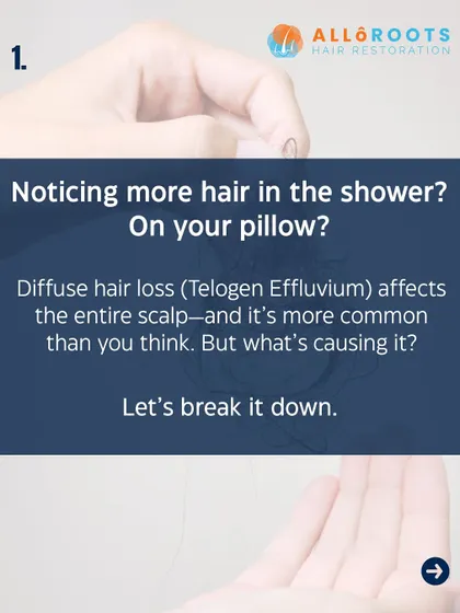 Noticing more hair on your pillow or in the shower drain? This could be Telogen Effluvium, a common form of diffuse hair loss that affects the entire scalp. Let's break down what might be causing it.