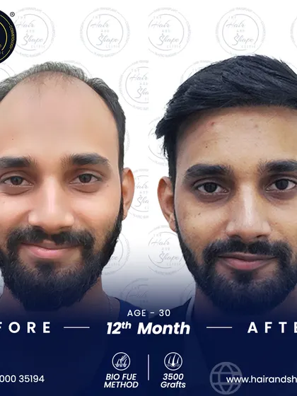 A complete transformation after 12 months using the BIO FUE method. With 3500 grafts, we achieved a full, youthful look that speaks for itself.