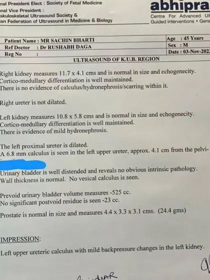 This is the "before" report. A patient's ultrasound from November 2023 clearly shows a 6.8 mm kidney stone, which was causing him extreme pain. This is the clinical starting point of our treatment journey.