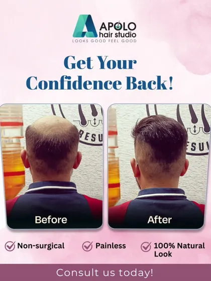 This rear view shows how our hair patches provide a natural look from behind. The hair is expertly blended and cut to match the client's existing hair for a seamless appearance.