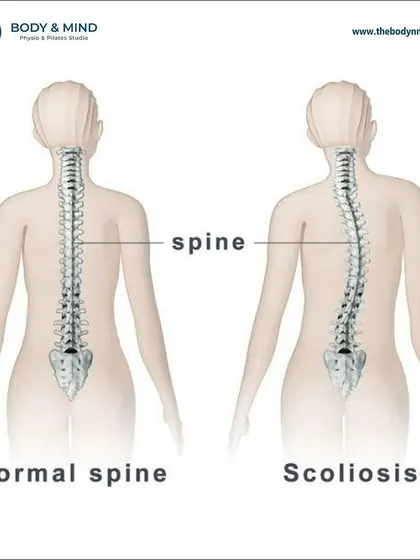 A clear comparison of a normal, straight spine versus a scoliotic spine. Understanding this visual difference helps clients recognize the importance of postural exercises in managing their condition.