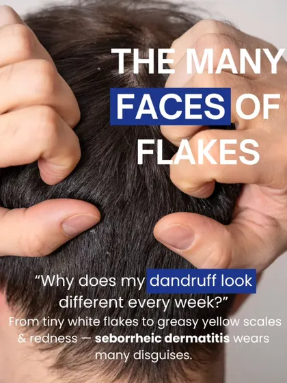 Dandruff, or seborrheic dermatitis, can present in many ways, from tiny white flakes to greasy yellow scales with redness. The appearance can change, but the underlying cause needs consistent management.