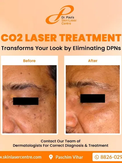 Here you can see the results of a CO2 laser treatment for eliminating DPNs, which are small, dark spots on the skin. The treatment effectively clears these spots for a more even complexion.