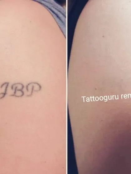 This shows the removal of initials from the shoulder area. Black ink like this generally responds very well to the laser treatment.
