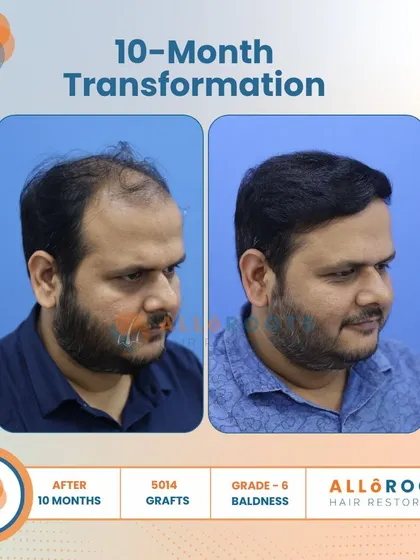 This 10-month transformation is a powerful example of tackling advanced Grade 6 baldness. With 5014 grafts, we achieved remarkable coverage and density, as seen from all angles.