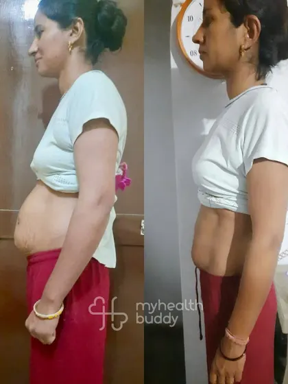 This mom of two toddlers healed her diastasis recti and fatty liver while losing 4 kgs in 3 months. She followed a simple plan with home-cooked food and saw amazing results.