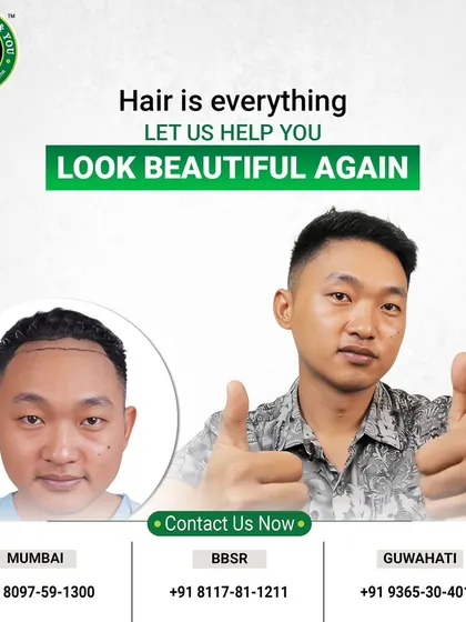 The thumbs-up says it all. This client's journey from a pre-marked hairline to a full, happy result is a testament to the effectiveness of a well-executed FUE hair transplant. It’s not just about hair, it’s about feeling great again.
