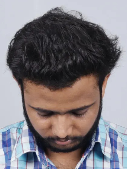 A fantastic 6-month result after implanting 5000 grafts. We recreated the hairline and filled the mid-scalp and crown area.