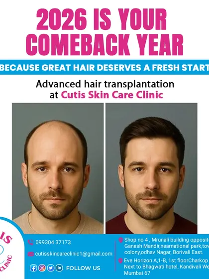 A clear before and after comparison of a male patient who underwent our advanced hair transplantation. The first image shows significant hair loss on the crown and frontal scalp, while the second image displays a full, natural-looking head of hair, demonstrating the effectiveness of the procedure.