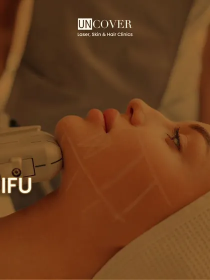 A close-up of a HIFU facial treatment. The grid markings help us ensure precise, even delivery of ultrasound energy across the target area for optimal lifting and tightening.