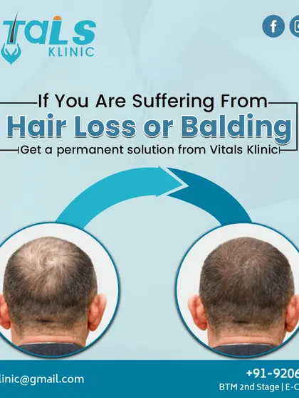 This before and after comparison demonstrates the effectiveness of hair transplantation in covering bald spots on the crown. Our goal is to provide a permanent solution that restores a fuller, more youthful appearance.