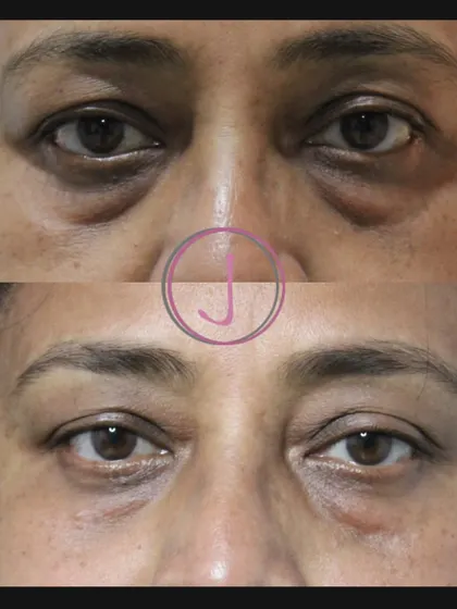 Tired of looking tired? Under-eye puffiness is a common concern, but it doesn't have to be permanent. This before-and-after shows the significant reduction in eye bags after just one session of PDO threads, helping my patient look rested and rejuvenated.