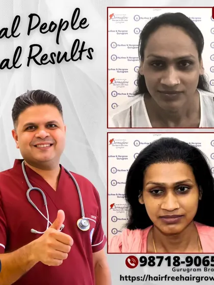 Another successful female hair transplant. This before-and-after comparison shows how we restored her frontal hairline with 1962 grafts, achieving a natural and fuller look that she was very happy with.