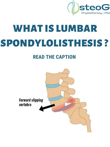 Lumbar Spondylolisthesis is a condition where a vertebra slips forward. This infographic explains the anatomy of the condition, which can cause significant lower back pain and requires careful management.