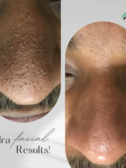 The before and after of a HydraFacial treatment focused on the nose area. You can clearly see the reduction in blackheads and clogged pores, resulting in a much smoother texture.