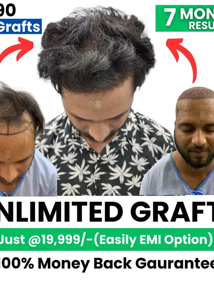 With 3590 grafts, this is the result after 7 months. We also offer a 100% money-back guarantee and easy EMI options.