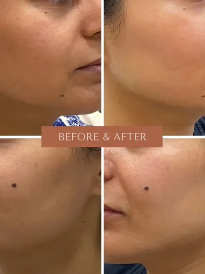 These images demonstrate the 'glass skin' effect achievable with AdvaTx. The treatment refines pores and smooths texture, creating a filter-like finish with zero downtime.