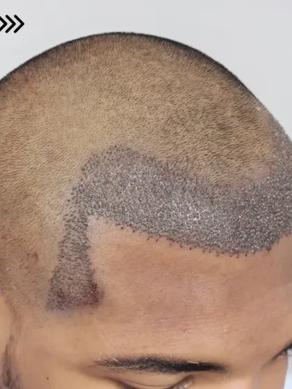 Fresh graft placement for a Grade 2 case. We used 2400 grafts to recreate the hairline, enhance the frontal region, and design natural temples.