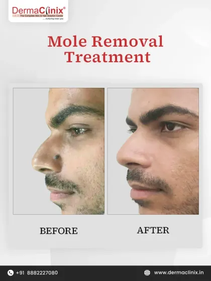 This before and after shows the result of our mole removal treatment. The procedure is performed with precision by our dermatologists to ensure a clean, scar-free outcome, enhancing the patient's natural features.