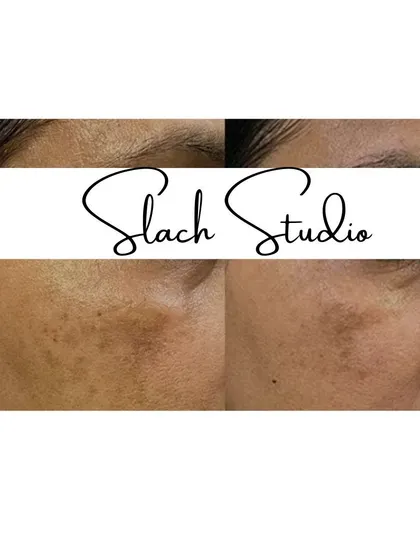 This before-and-after shows the successful treatment of patchy pigmentation, leading to a more even and consistent skin tone.