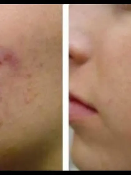 A clear example of how targeted laser treatments can significantly reduce the appearance of widespread acne scarring. The "after" photo shows a much smoother canvas, with less shadowing and a healthier overall appearance.