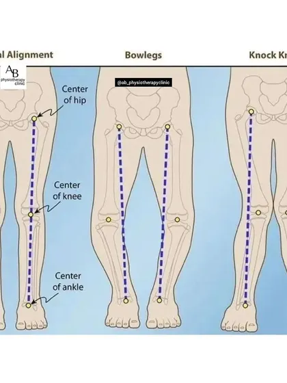 This diagram compares normal leg alignment with bowlegs and knock knees. These structural issues can affect your gait and lead to knee, hip, and back pain over time, which can be managed with corrective exercises.