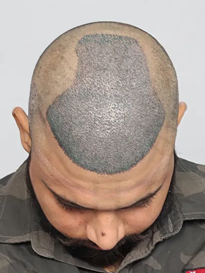 This is what a scalp looks like immediately after the procedure. Each dot is a carefully placed graft, the foundation of a future full head of hair.