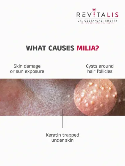 What Causes Milia to Form? Milia can be caused by sun damage, the use of heavy skin products, or cysts around hair follicles. Understanding the cause is the first step to effective treatment.