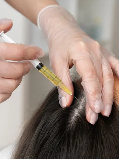 Here is a close-up of a PRP injection being administered to the scalp. The procedure is precise and targets areas of thinning to revitalize hair follicles. It is a safe and minimally invasive way to encourage natural hair regrowth.