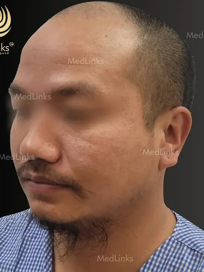 The patient's hair from the side before the procedure.