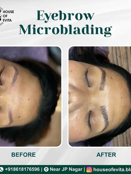 This before-and-after demonstrates how Microblading can add density and structure. The new brows look fuller and more polished.