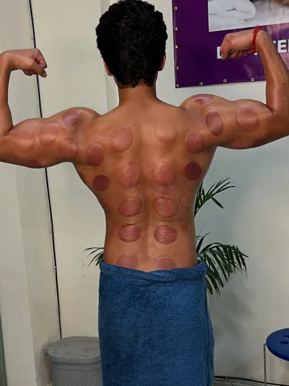 Fitness model Sumit showing the after-effects of cupping on his back.