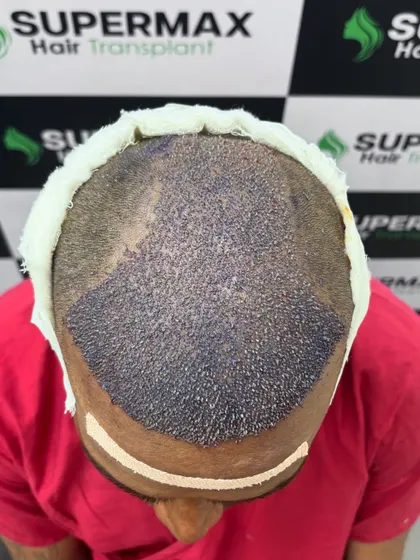 Another view of the 5400 grafts implanted in a single day. We work efficiently to give you maximum results.